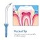 Ronsit Replacement PeriodontalPocket Tips Compatible with Waterpik Water Flossers and Other Brand Oral Irrigators 4Pack