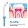 Ronsit Replacement PeriodontalPocket Tips Compatible with Waterpik Water Flossers and Other Brand Oral Irrigators 4Pack