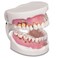 Practicon 4112128 Pathological Gingivitis Model