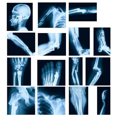 Sayglossy 15 Pcs Broken Bones x Ray Set Human x Rays Black and Blue Skeleton Pretend Xrays for Kids