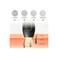 IPL Hair Removal Device ZP575   5 Energy Levels   500,000 Flashes   3 Modes   Painless Laser