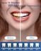 MySmile Teeth Whitening Kit with Whitening Light, Non-Sensitive Teeth Whitener Kit with 4 Teeth Whitening Gel,10 Min Fast-Result Home Tooth Whitening Dental Care Help Remove Teeth Stain