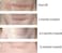 Improscar Stick 50 - World&rsquo;S First, Patented, Silicone-Based Stick For Scar Treatment With SPF 50 - Making Scars Less Visible, 5 G