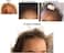Improscar Stick 50 - World&rsquo;S First, Patented, Silicone-Based Stick For Scar Treatment With SPF 50 - Making Scars Less Visible, 5 G