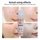Acne Treatment Serum with Collagen &ndash; Fast-Acting Pimple &amp; Scar Repair Serum for Clear Skin, Oil Control &amp; Acne Spot Reduction