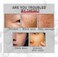 Collagen Boost Anti-Aging Face Serum with Hyaluronic Acid &amp; Vitamin C &ndash; Firming Skin Care for Wrinkles, Hydration &amp; Youthful Glow