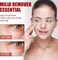 Milia Removal Face Serum &ndash; Skin Smoothing Spot Treatment Serum for Face Care, Helps Improve Bumpy Skin Texture &amp; Clearer Looking Skin