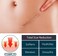 Advanced Skin Renewal Silicone Gel &ndash; Scar &amp; Stretch Mark Care Gel for Smooth Skin Appearance, Supports Old &amp; New Scar Visibility Reduction