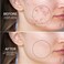 Bee Venom Acne Cream 20g &ndash; Anti-Acne Facial Treatment Cream for Pimple-Prone Skin, Moisturizing Skin Care &amp; Blemish Appearance Reduction