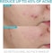 La Roche Posay Effaclar Serum Ultra Concentrated 30ml